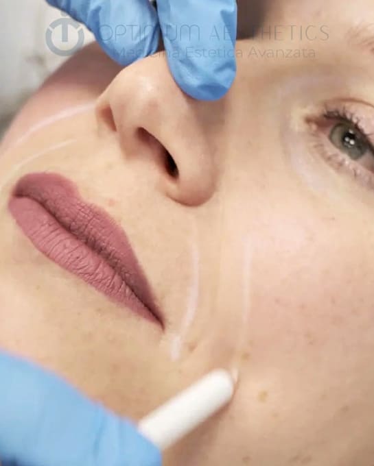 Filler acido ialuronico